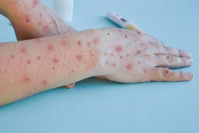 Mpox no RS: Secretaria da Saúde confirma cinco casos no Estado, nenhum da nova cepa da doença