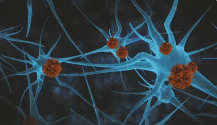 Droga experimental retarda a progressão do Alzheimer em 60% para pacientes em estágios iniciais da doença