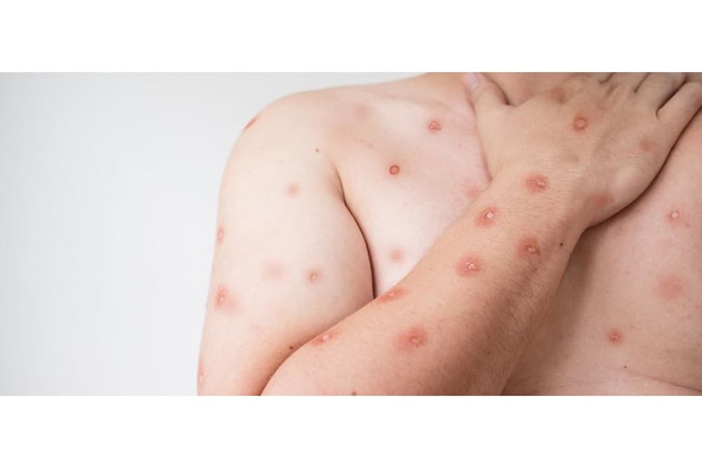 Mpox no RS: com letalidade similar a da gripe, doença deve ter expansão de casos, projeta pesquisador